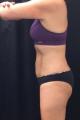 coolsculpting-