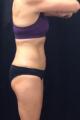 coolsculpting-