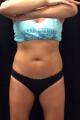 coolsculpting-