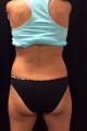 coolsculpting-
