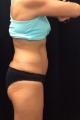 coolsculpting-