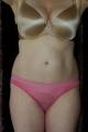 coolsculpting-