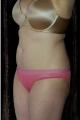 coolsculpting-