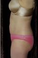 coolsculpting-
