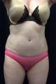 coolsculpting-