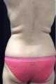 coolsculpting-