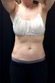 coolsculpting-