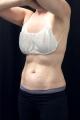 coolsculpting-