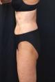 coolsculpting-