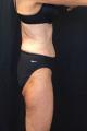 coolsculpting-