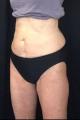 coolsculpting-