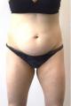 coolsculpting-