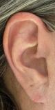 earlobe-repair-