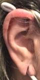 earlobe-repair-