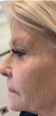 rha-filler-