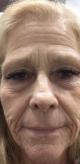 rha-filler-