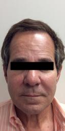 juvederm-