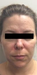 juvederm-