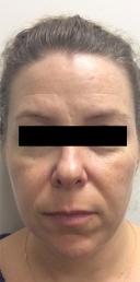 juvederm-