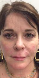 juvederm-