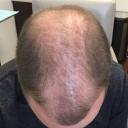 prp-hair-restoration-