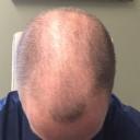 prp-hair-restoration-
