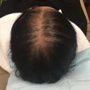 prp-hair-restoration-