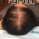 prp-hair-restoration-