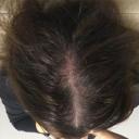 prp-hair-restoration-