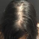 prp-hair-restoration-