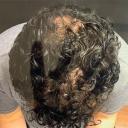 prp-hair-restoration-