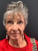 smartskin-co2-resurfacing-laser-