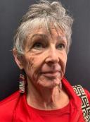 smartskin-co2-resurfacing-laser-